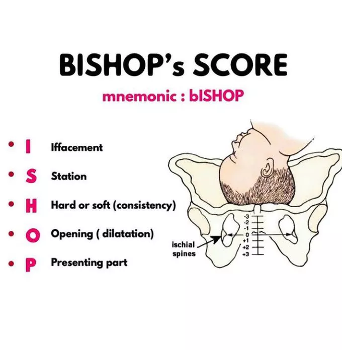 What is a Bishop Score?